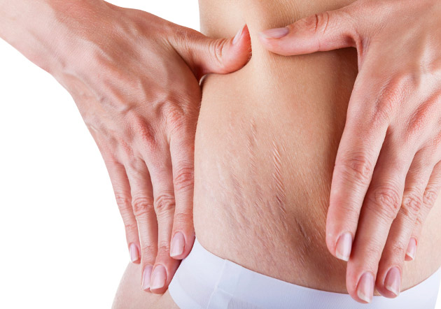 Woman's hands pinching stretch marks on hips