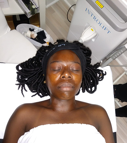 Client undergoing a perfect derma peel at Introlift 