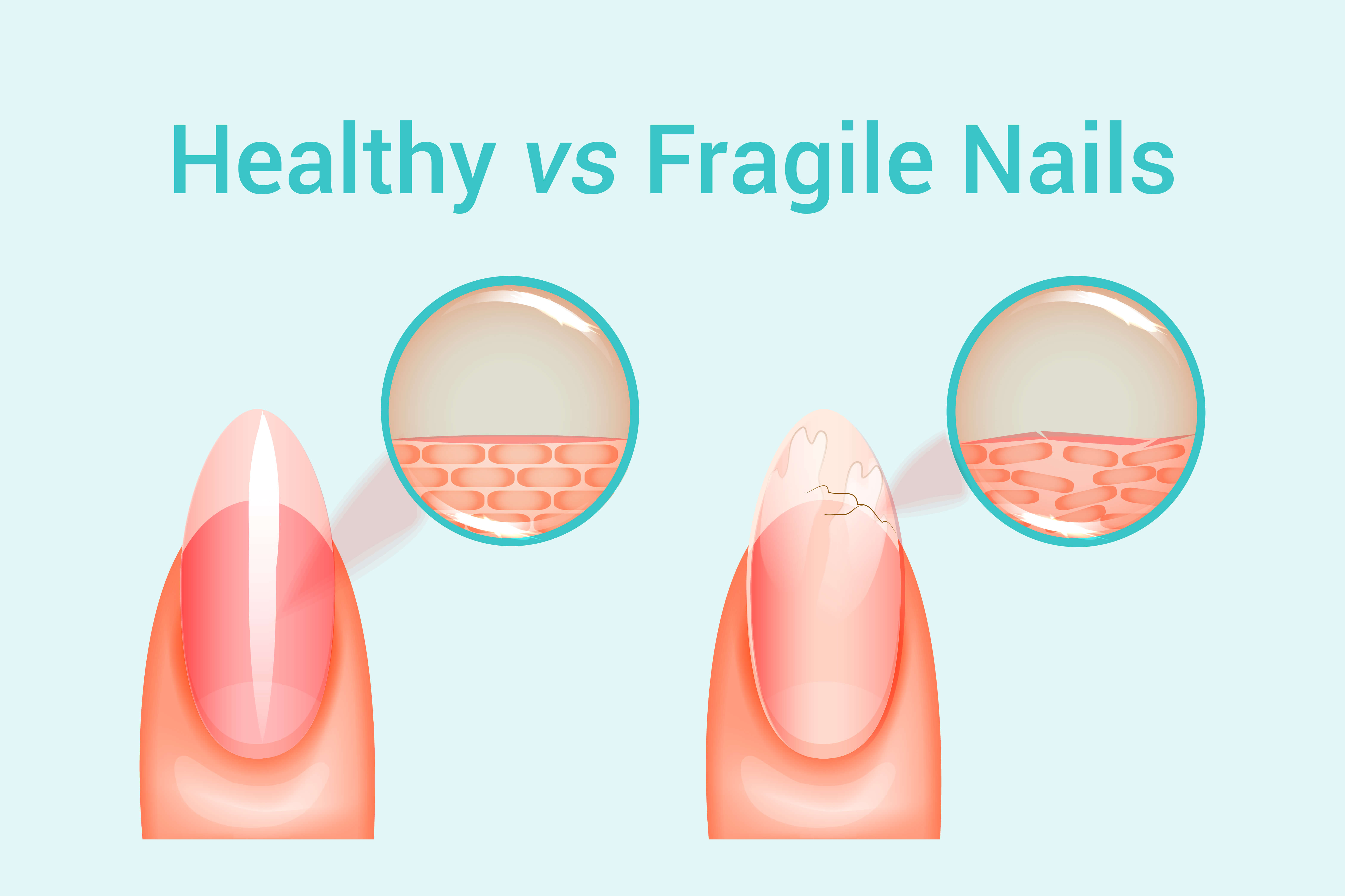 Illustration of healthy versus fragile nail